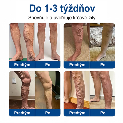 🇺🇸👨‍⚕️✅ Medistart® VeinRepair – mikrotűs ápoló tapasz ⚡ Azonnali megkönnyebbülés, hosszan tartó eredmény
