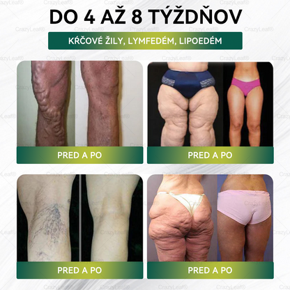 🎉 Gratulujeme! Dnes ste jednou zo šťastných zákazníčok. 🎁 Ako špeciálny darček získavate extra 50 % zľavu! Začnite už dnes s CrazyLeaf® a vykročte k zdravšiemu a krajšiemu životu. 🌿✨