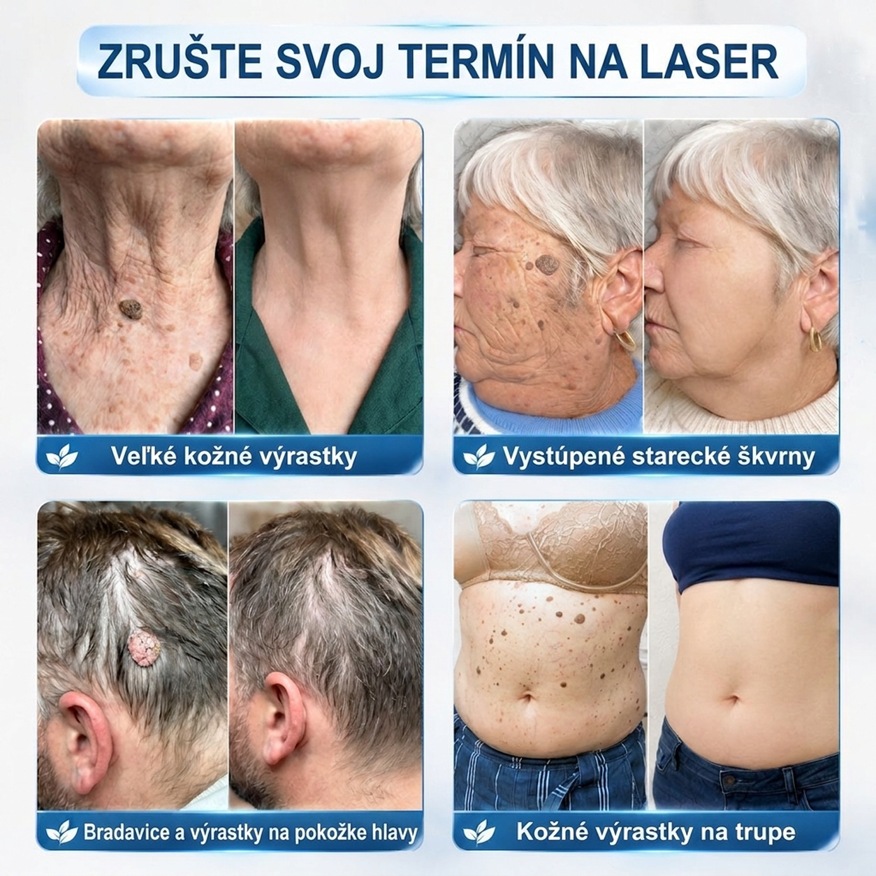 ✅PuraCure® 👩‍⚕️ 7-dňové pero na odstraňovanie kožných výrastkov a znamienok – bezbolestný a bez jaziev, profesionálny valčekový aplikátor