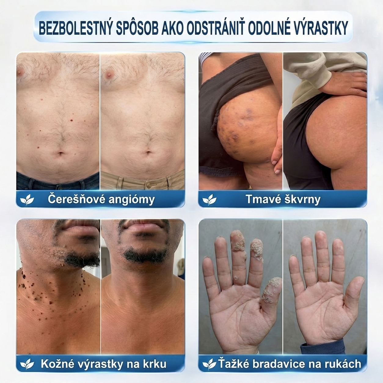 ✅PuraCure® 👩‍⚕️ 7-dňové pero na odstraňovanie kožných výrastkov a znamienok – bezbolestný a bez jaziev, profesionálny valčekový aplikátor