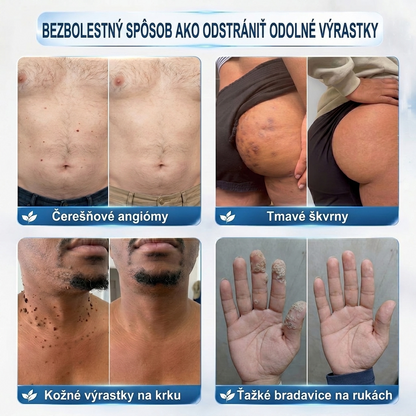 ✅PuraCure® 👩‍⚕️ 7-dňové pero na odstraňovanie kožných výrastkov a znamienok – bezbolestný a bez jaziev, profesionálny valčekový aplikátor