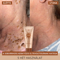 💟FRISSARC™ fehérítő és folteltávolító arcmaszk