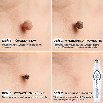 ✅PuraCure® 👩‍⚕️ 7-dňové pero na odstraňovanie kožných výrastkov a znamienok – bezbolestný a bez jaziev, profesionálny valčekový aplikátor