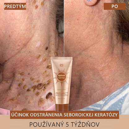 FRISSARC™ bieliaca a škvrny odstraňujúca pleťová maska – 🌿Prírodné zložky trvalo odstraňujú pigmentové škvrny, starecké škvrny, pehy a slnečné škvrny.